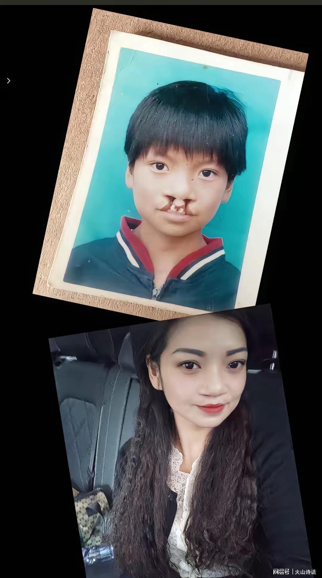 NFL-震惊！为声援李亚鹏，一漂亮女孩坦然展示自己唇腭裂手术前后照片